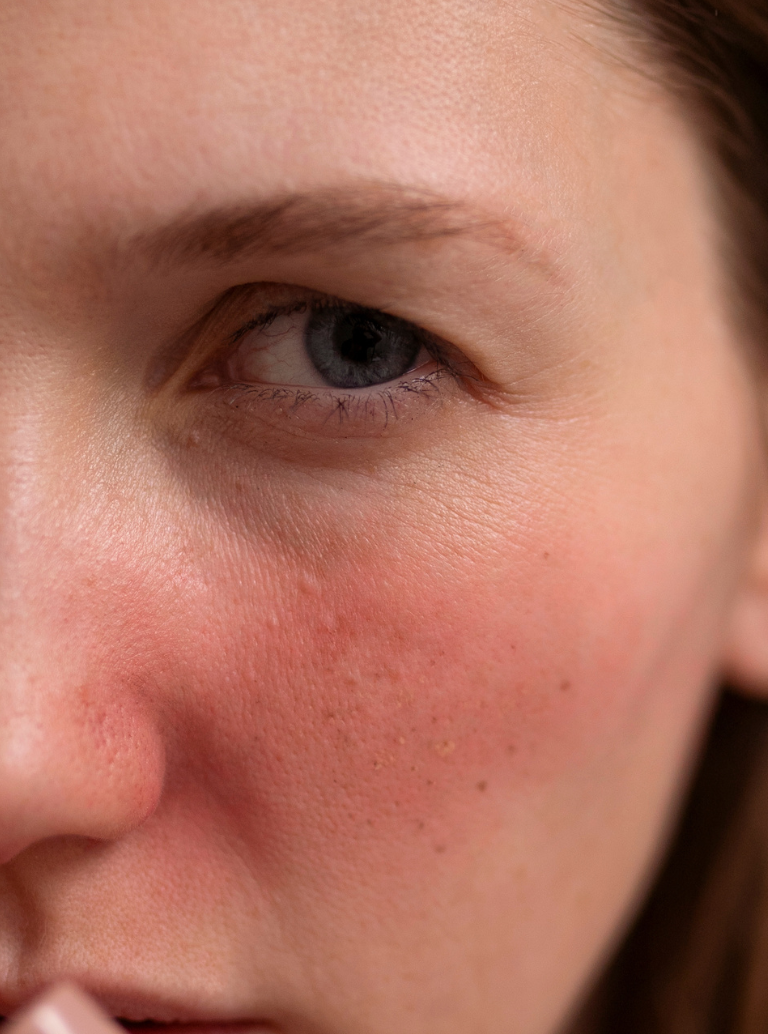 Pele sensível e rosácea: como cuidar com segurança e eficácia