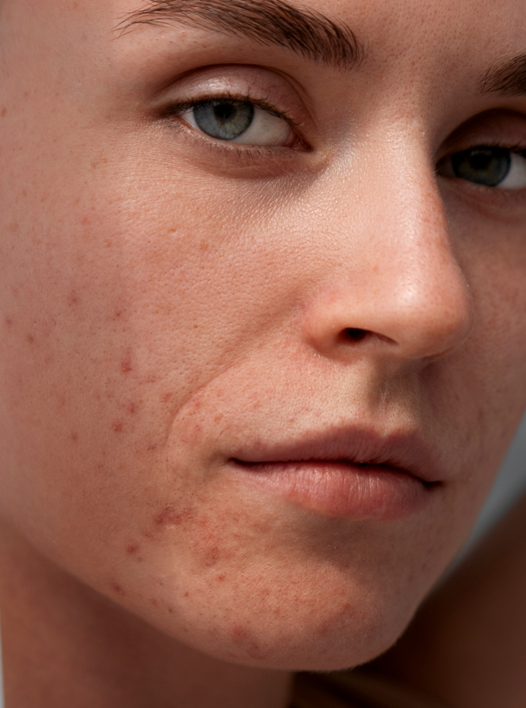 Acne Adulta