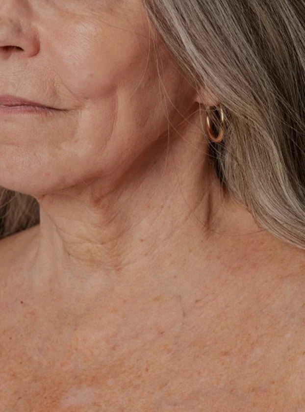 Rugas e Linhas de Expressão