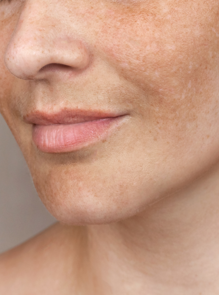 Melasma e Manchas Escuras