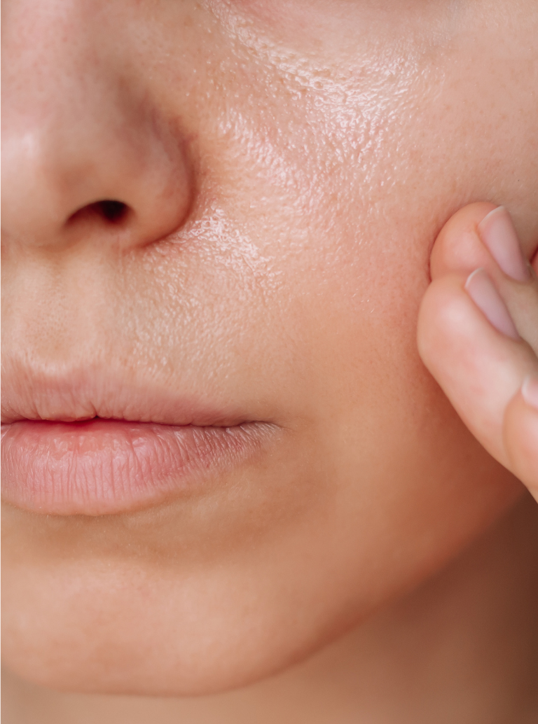 Oleosidade Excessiva