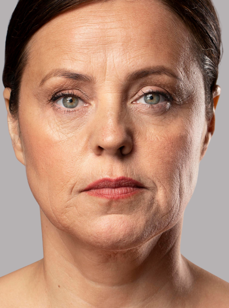 Rugas e Linhas de Expressão