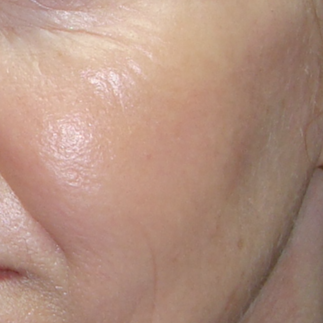 Close-up of a person's cheek and eye area, showing skin texture and wrinkles.