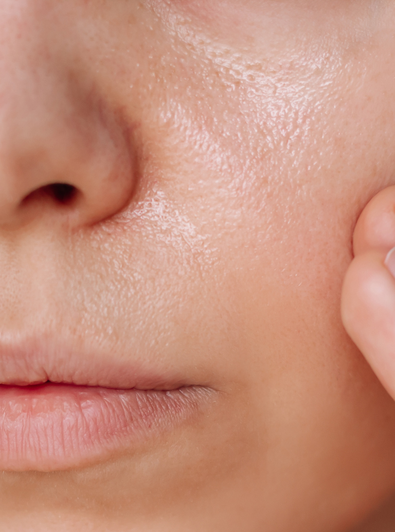 Pele Oleosa com Brilho Excessivo