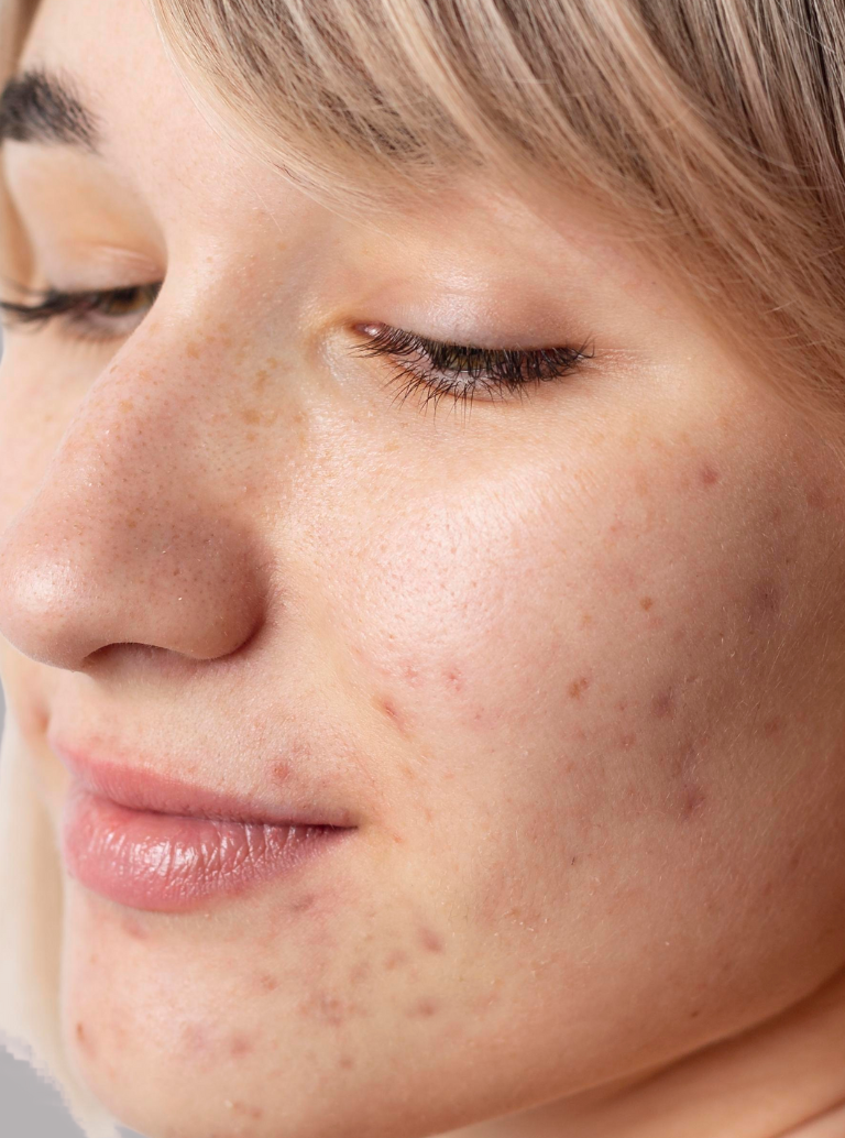 Pós-Inflamação e Marcas de Acne
