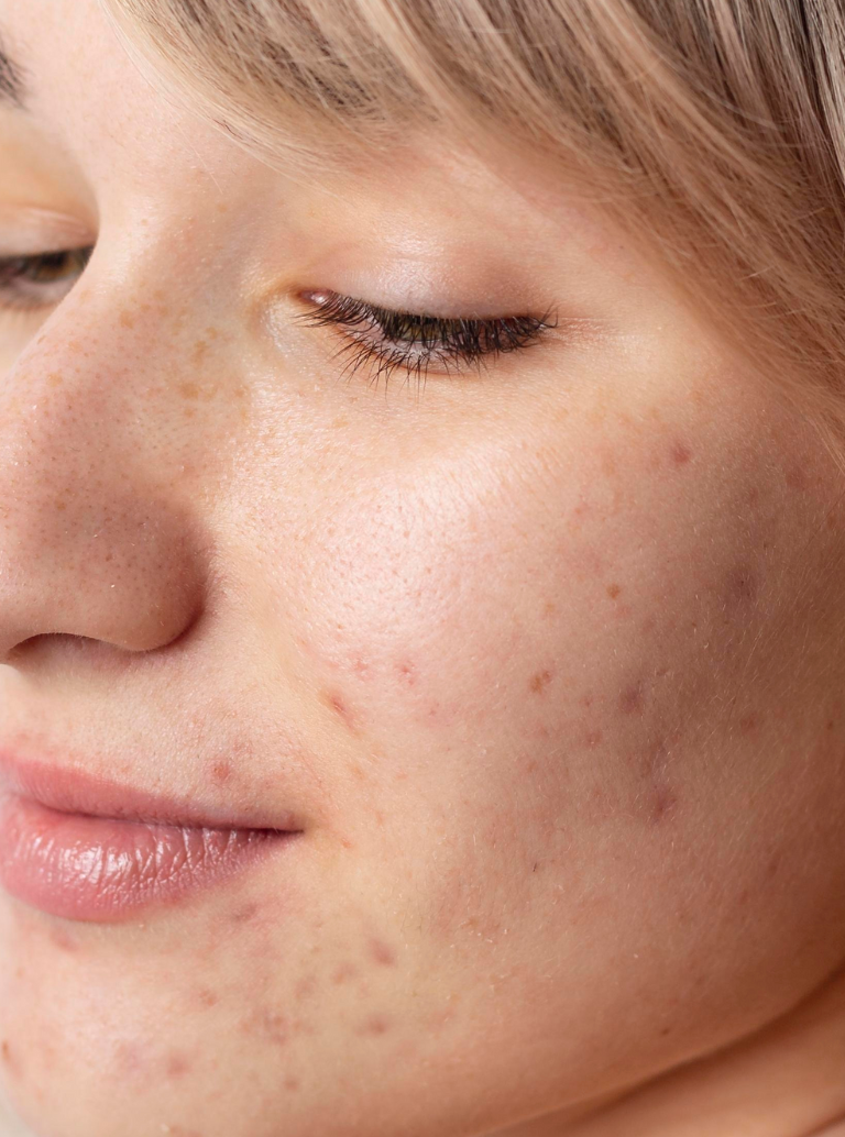 Prevenção de Marcas e Cicatrizes