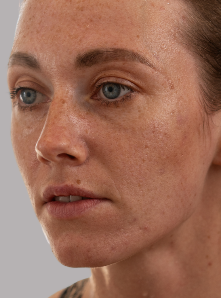 Ressecamento e Sensações de Ardência