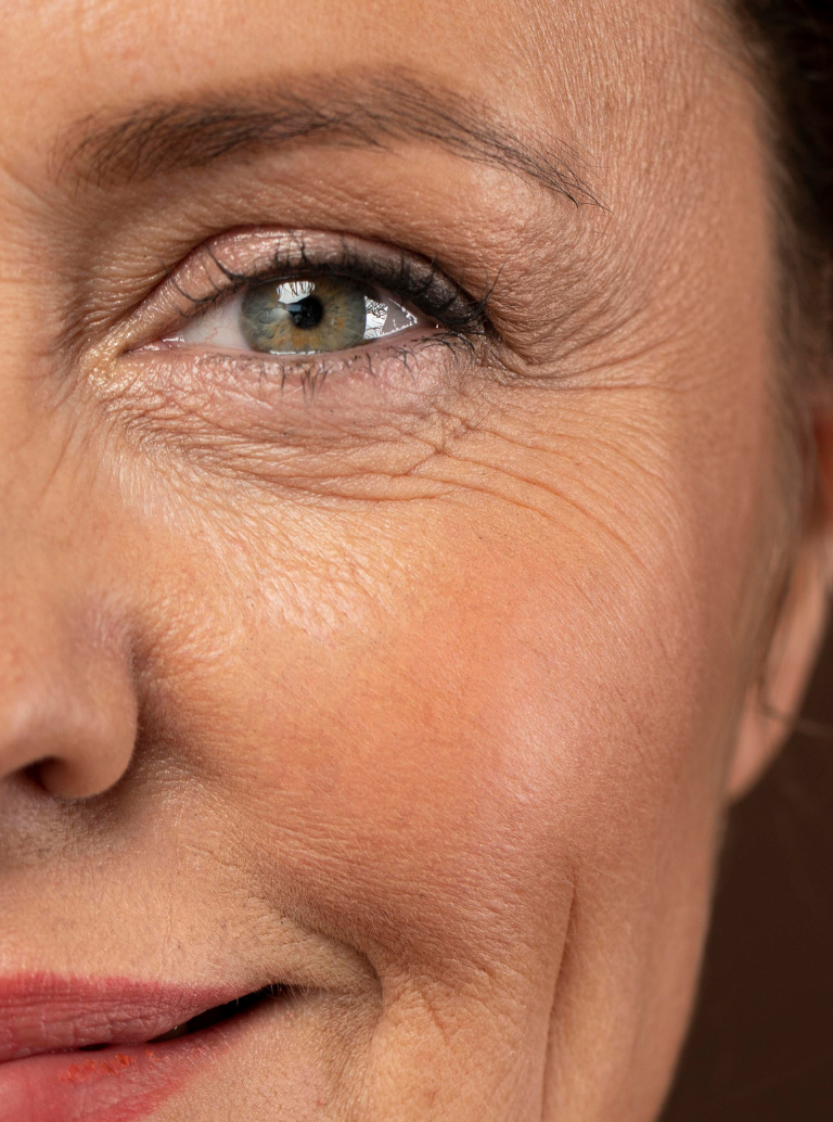 Rugas Marcadas e Flacidez